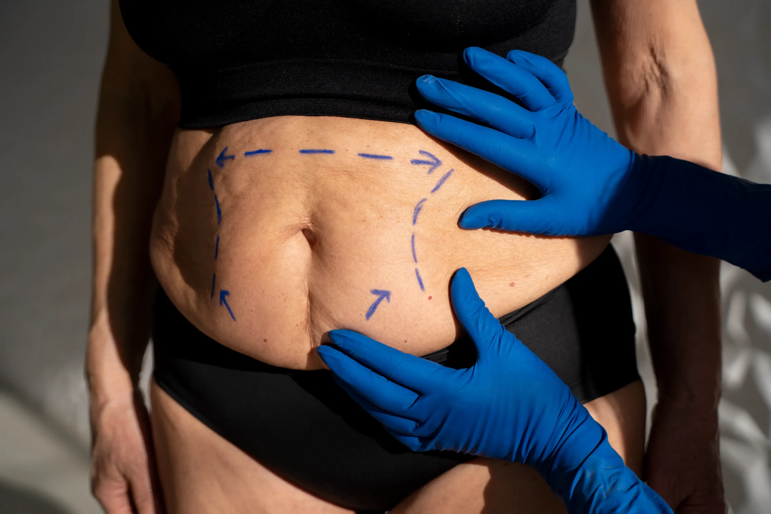 Belly fat reduction