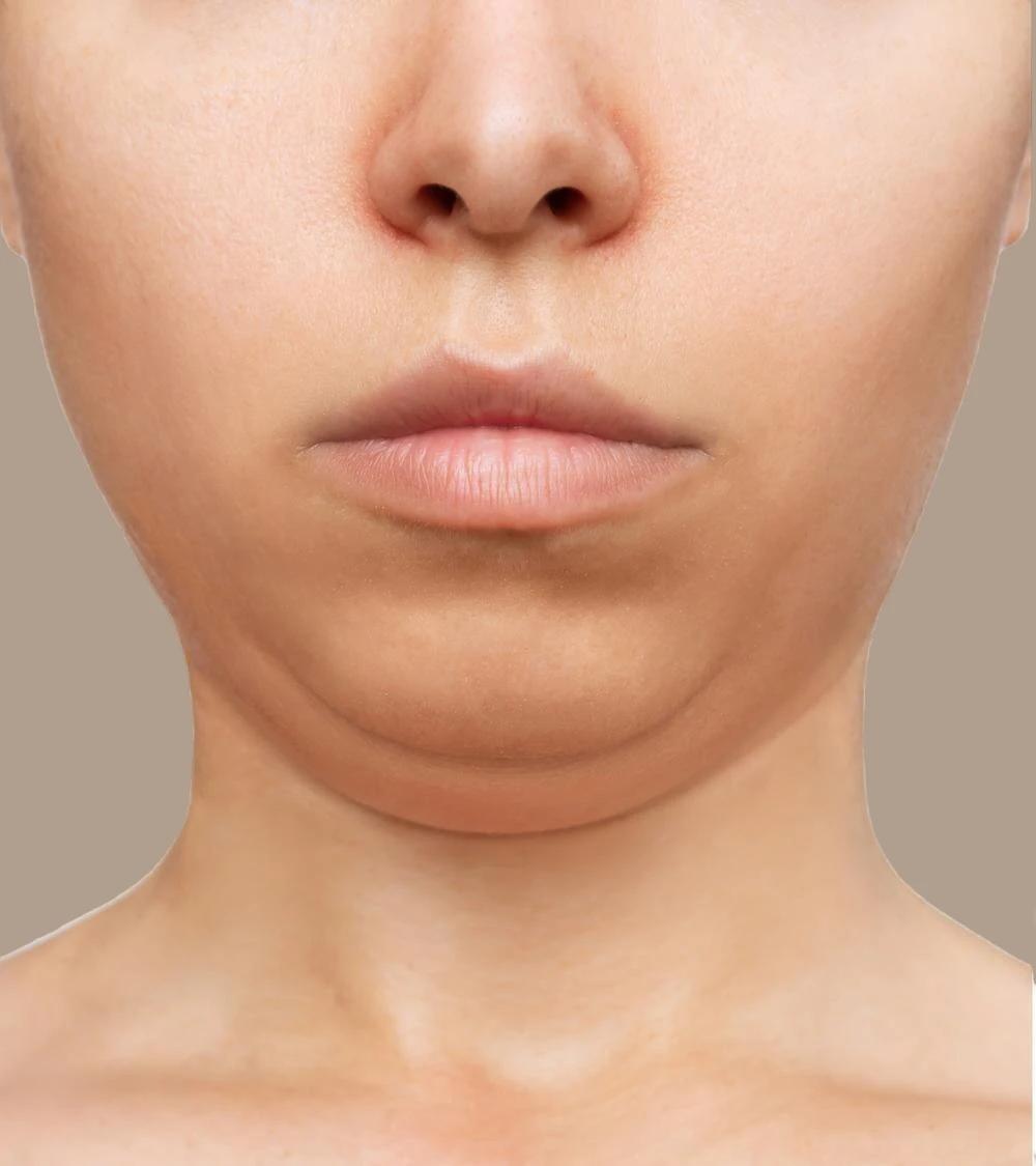 before-double-chin-reduction