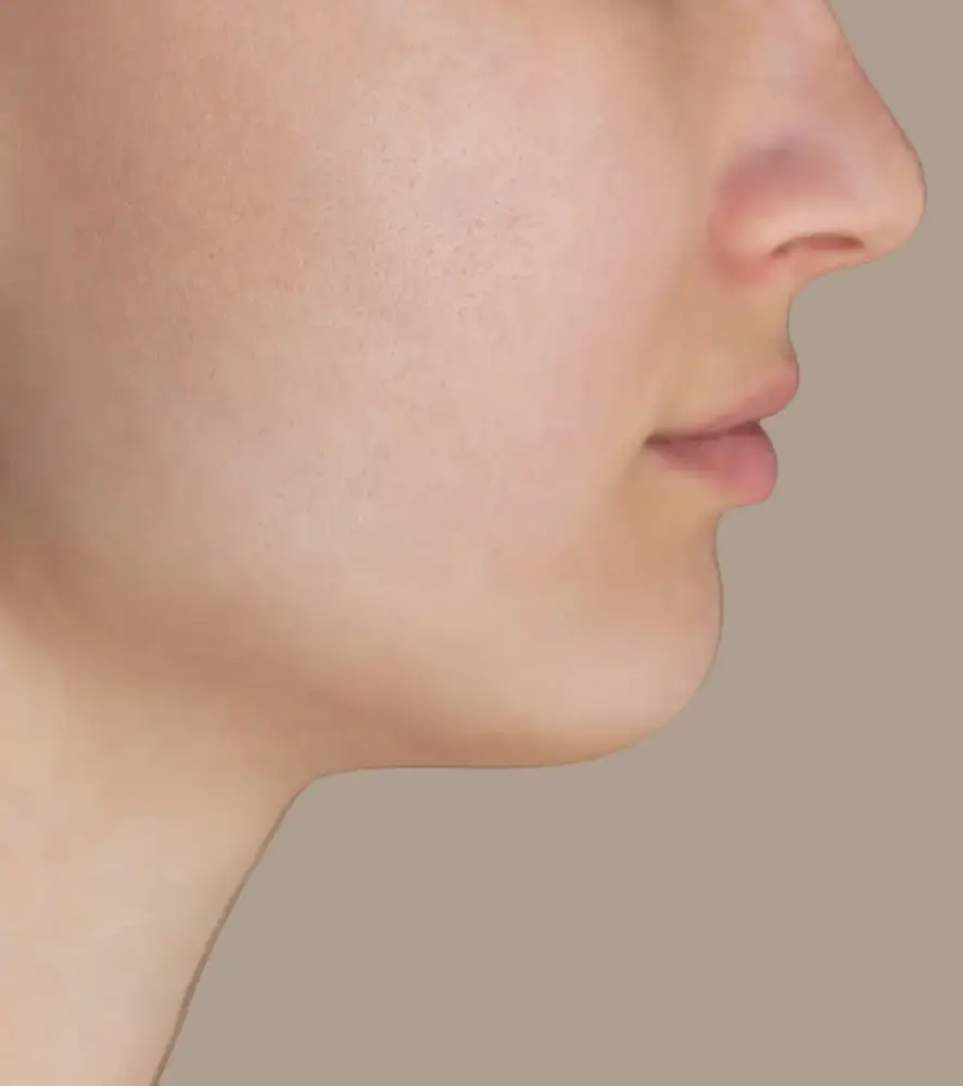chemical peel after