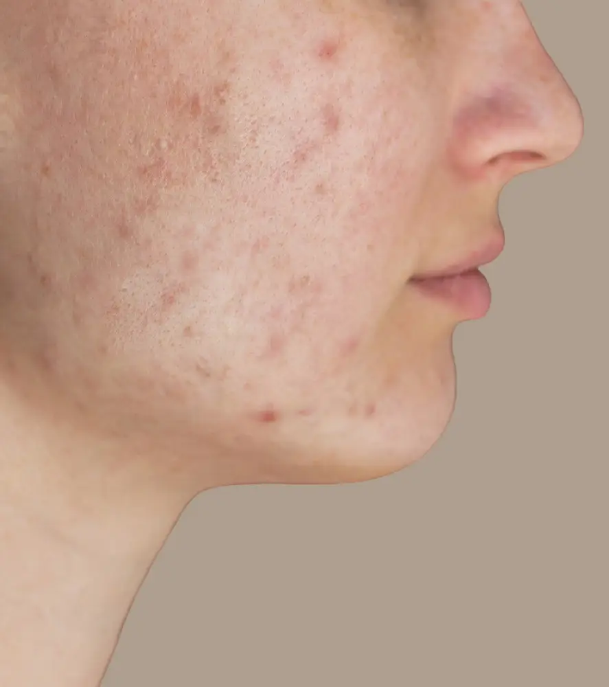 chemical peel before