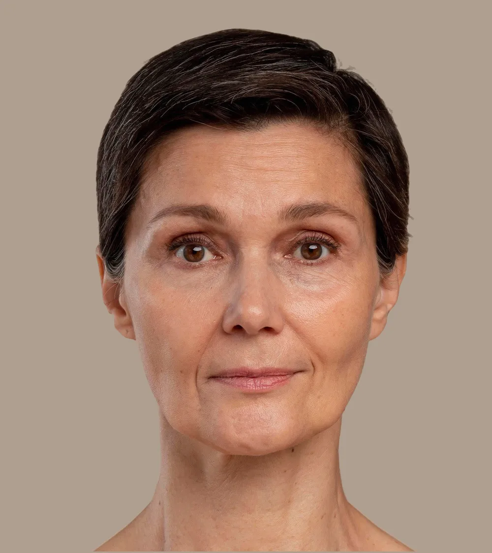 before-botox-treatment