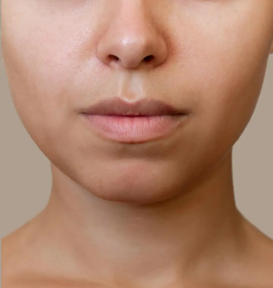 dermal filler after