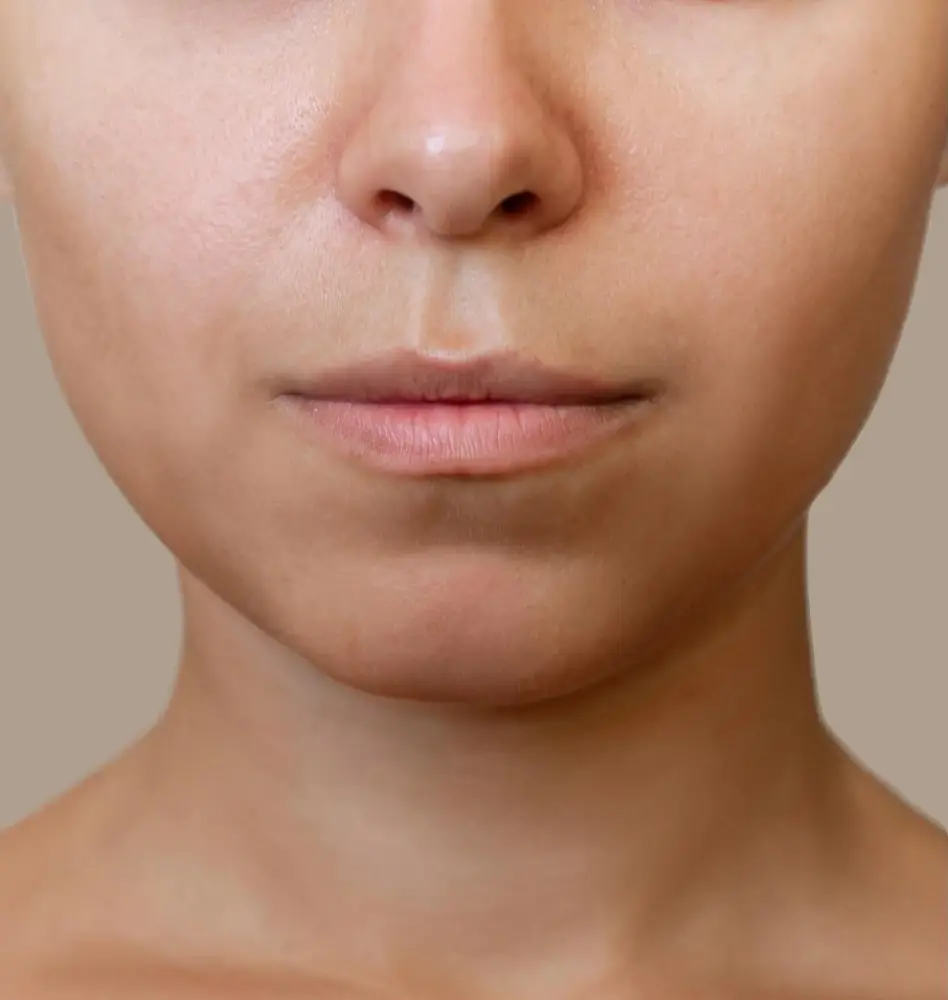dermal filler before